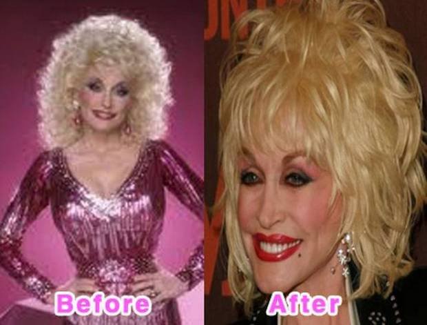 Dolly Partonのビフォーアフター